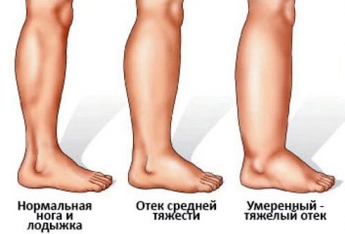 Онемение ног и рук